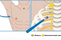 Схема симпатэктомии Схема симпатэктомии