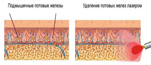 Схема удаления потовых желез Схема удаления потовых желез