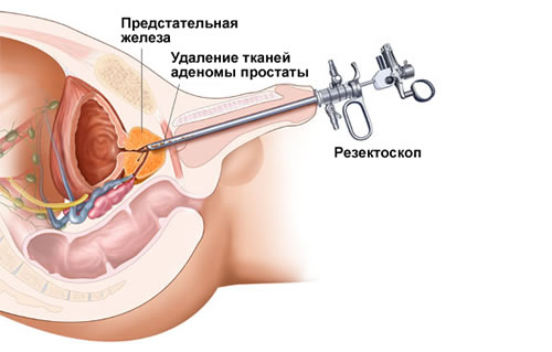 Схема удаления тканей аденомы простаты Схема удаления тканей аденомы простаты
