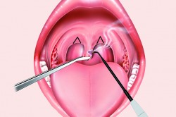 Схема увулопалатопластики