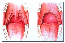 Схема увулопластики Схема увулопластики
