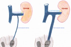 Схема варикоцеле Схема варикоцеле