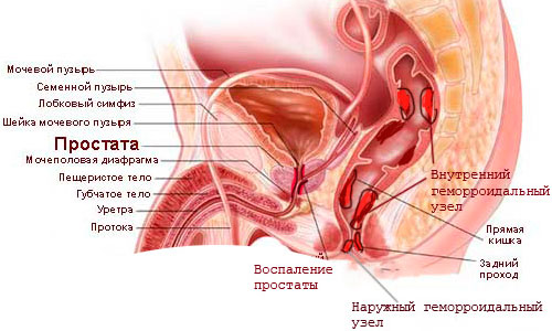 Схема воспаления простаты Схема воспаления простаты