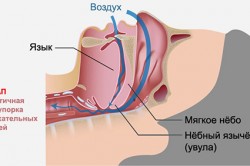 Схема возникновения храпа Схема возникновения храпа