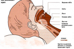 Схема возникновения храпа Схема возникновения храпа