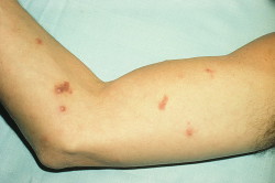 СПИД - кожные проявления СПИД - кожные проявления