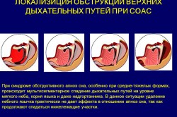 Синдром обструктивного апноэ сна Синдром обструктивного апноэ сна