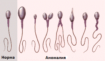 Сперматозоиды - норма ианомалия Сперматозоиды - норма ианомалия