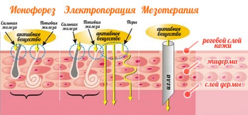 Сравнение ионофореза с другими методами Сравнение ионофореза с другими методами