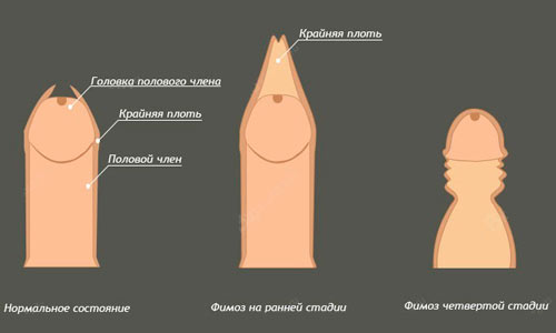 Стадии фимоза Стадии фимоза