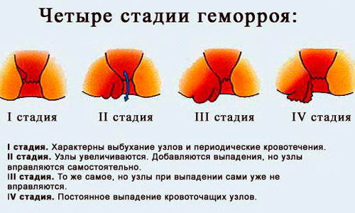Стадии геморроя Стадии геморроя