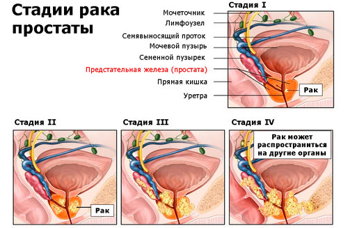 Стадии рака простаты Стадии рака простаты