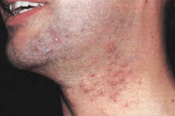 Стафилококковое импетиго Стафилококковое импетиго