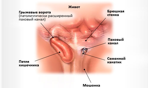 Строение паховой грыжи Строение паховой грыжи