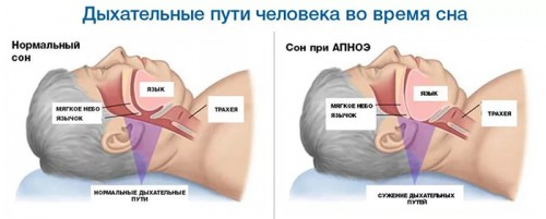 Сужение дыхательных путей во сне Сужение дыхательных путей во сне