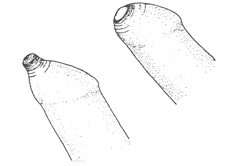 Сужение крайней плоти Сужение крайней плоти