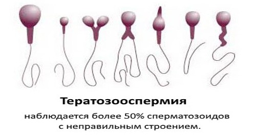 Тератозооспермия