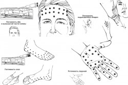 Точки инъекций ботулотоксина Точки инъекций ботулотоксина