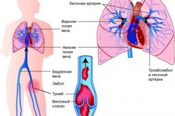 Тромбоэмболия легочной артерии Тромбоэмболия легочной артерии