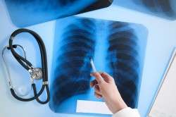 Туберкулез легких Туберкулез легких