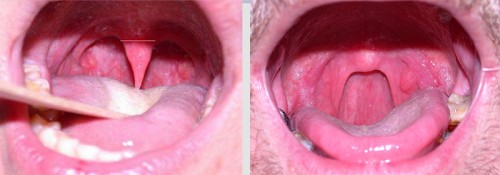 Удаление небного язычка Удаление небного язычка