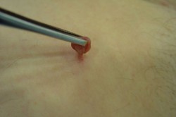 Удаление папиллом Удаление папиллом