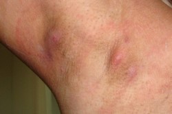 Увеличение лимфоузлов Увеличение лимфоузлов