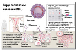 ВПЧ вызывает рак ВПЧ вызывает рак