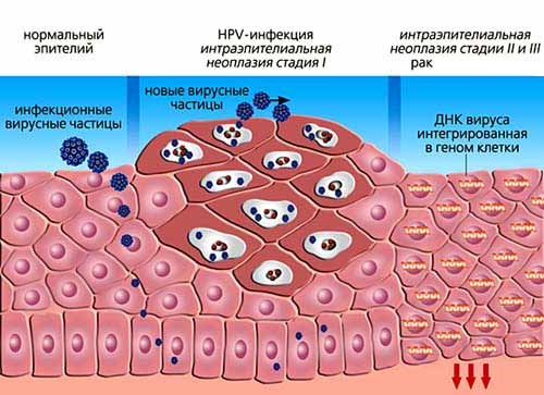 ВПЧ- вирус паппиломы человека ВПЧ- вирус паппиломы человека