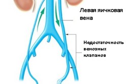 Варикоцеле Варикоцеле