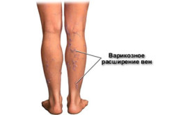 Варикозное расширение вен Варикозное расширение вен