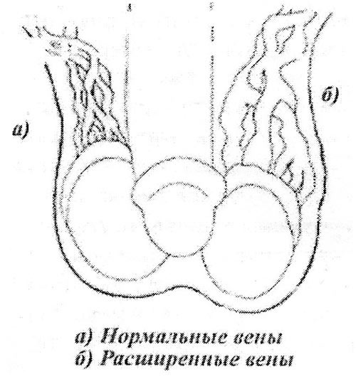 Варикозное расширение вен семенного канатика Варикозное расширение вен семенного канатика