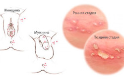 Вирус герпеса