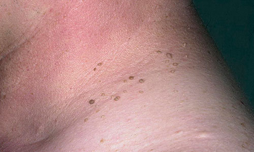 Вирус папилломы на шее Вирус папилломы на шее