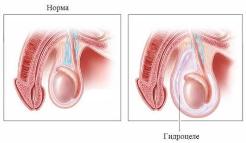 Водянка яичек Водянка яичек