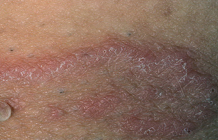 Воспаление в паху Воспаление в паху