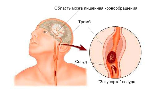 Причина возникновение инсульта