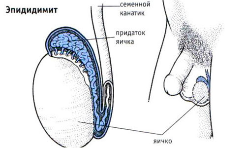 Возникновение эпидидимита Возникновение эпидидимита