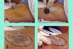 Введение ботокса в подмышечную впадину Введение ботокса в подмышечную впадину