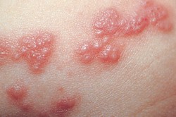 Высыпания на коже тела Высыпания на коже тела
