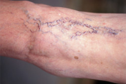 Заболевание вен Заболевание вен