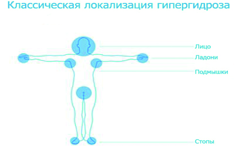 Зоны локализации гипергидроза Зоны локализации гипергидроза