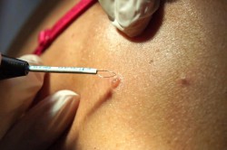 Удаление родинки радиоволновым методом Удаление родинки радиоволновым методом