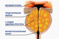 Аденома простаты Аденома простаты