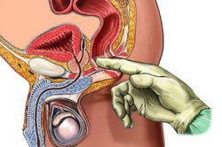 Трансректальное пальцевое исследование Трансректальное пальцевое исследование