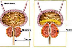 Аденома простаты Аденома простаты