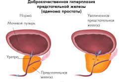 Доброкачественная гиперплазия простаты Доброкачественная гиперплазия простаты