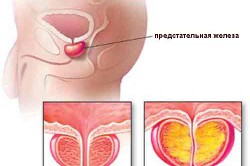 Здоровая и воспаленная простата Здоровая и воспаленная простата