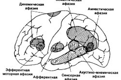 Афазия Афазия