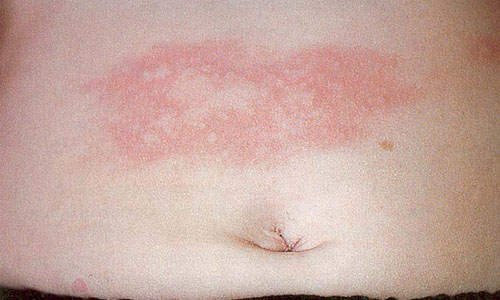 Аллергическая реакция Аллергическая реакция